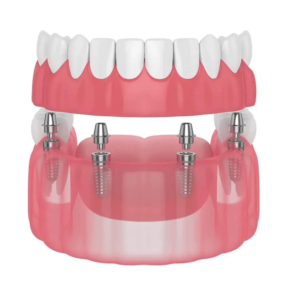 All on fours dental implants oklahoma