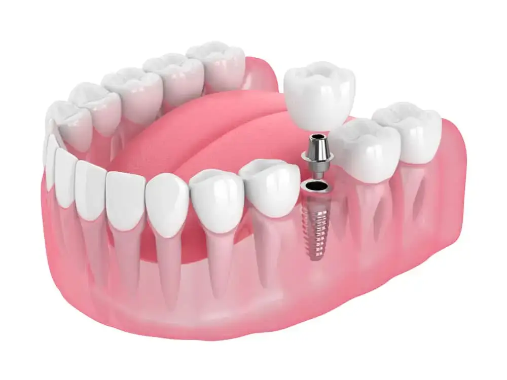 Single Tooth Dental Implants in Yukon OK