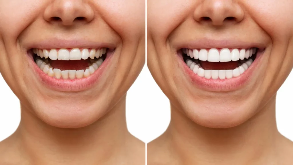woman-before-after-veneers-installation-comparison