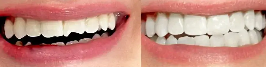 Cosmetic-Dentistry-before-and-after-chipped-tooth