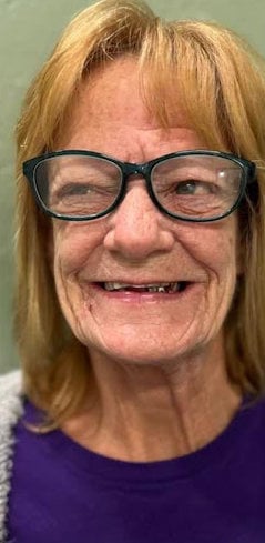 Before - Poorly Designed Dentures Before - Poorly Designed Dentures