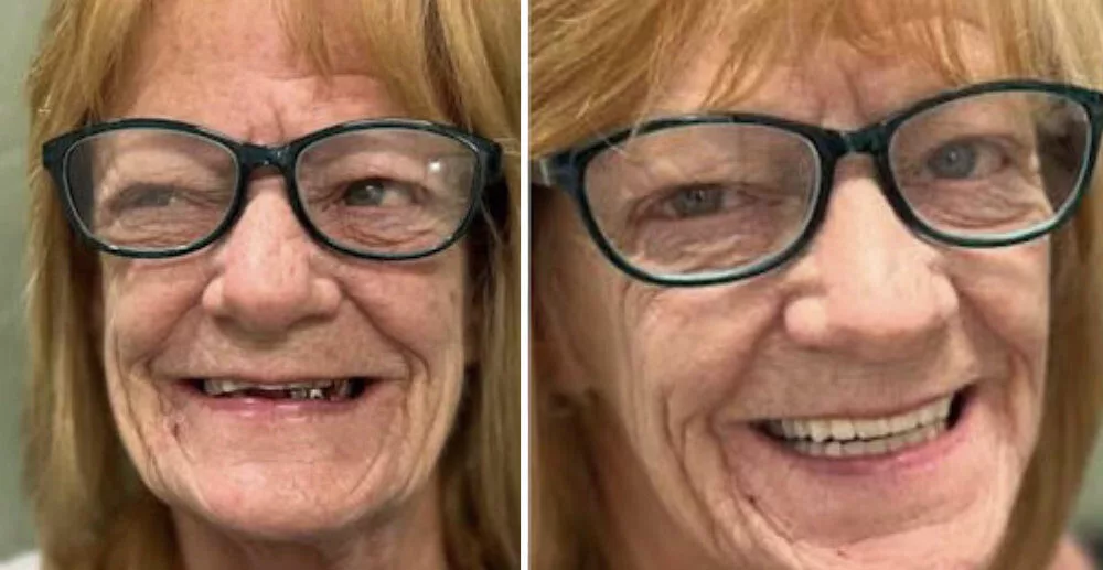 Before and After - Bad Dentures to Good Dentures