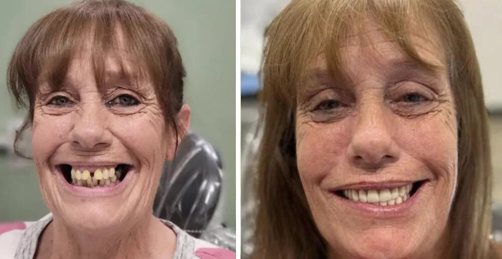 Before and After Dental Implants - Female