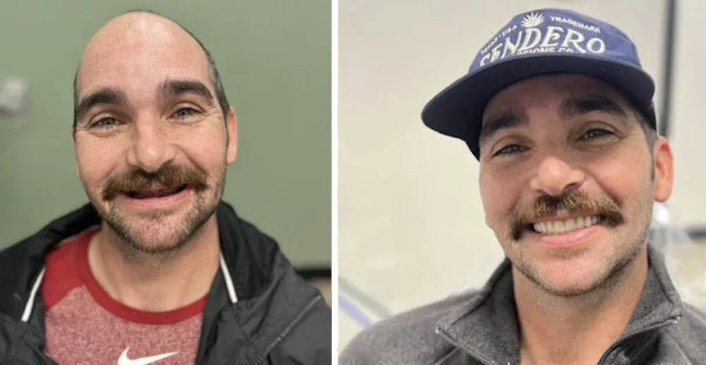 Before and After Dental Implants Male