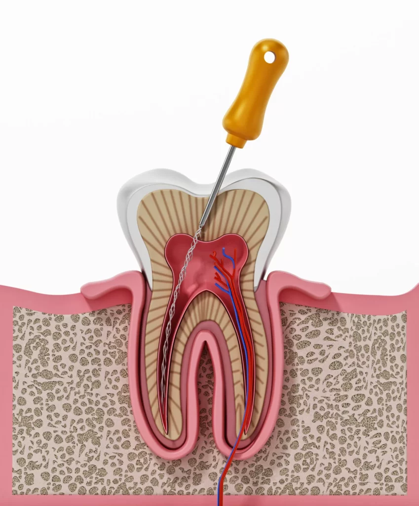 3d-illustration-root-canal-treatment-process 3d-illustration-root-canal-treatment-process