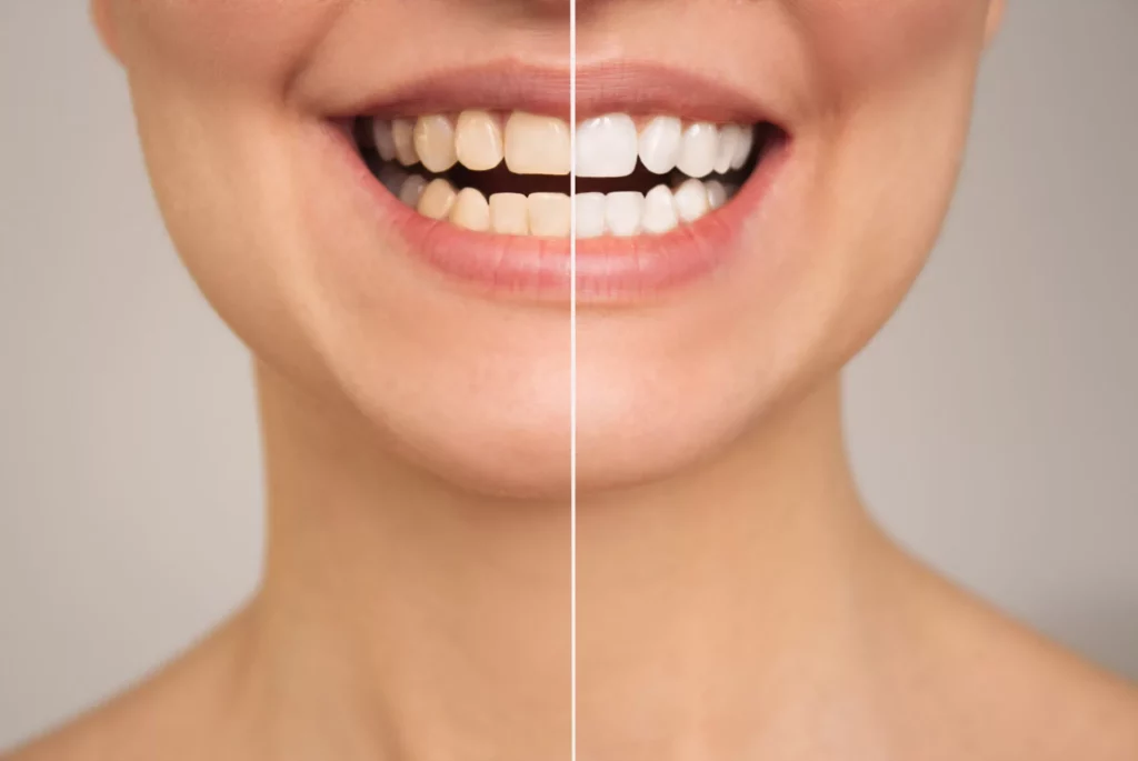 closeup-women-s-teeth-before-after-whitening-concept-comparison-aesthetic-dentistry closeup-women-s-teeth-before-after-whitening-concept-comparison-aesthetic-dentistry