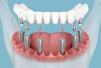 What Yukon Families Should Know About Dental Implants