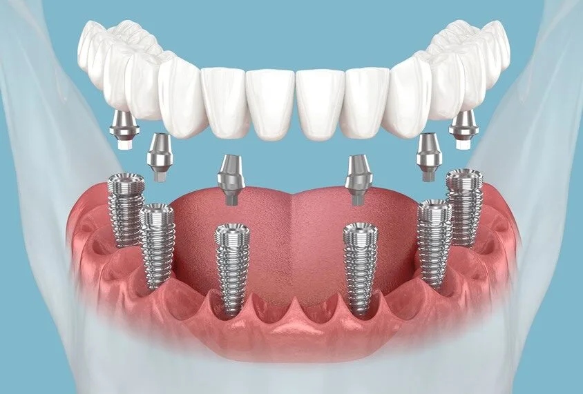 What Yukon Families Should Know About Dental Implants 51 Families
