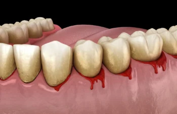 Close-up of unhealthy gums showing irritation and signs you need to visit a dentist