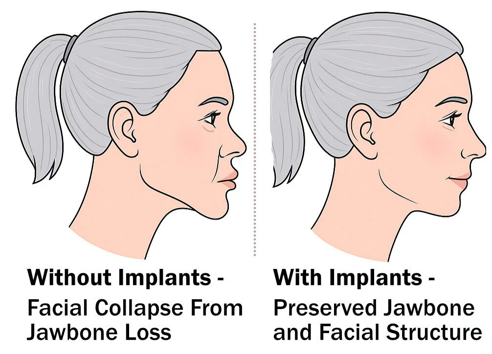 Jawbone preservation using dental implants