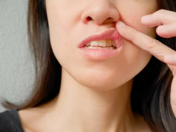 Oral health warning signs such as mouth sores and patches indicating you need to visit a dentist