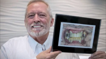 How Old Are Most People Who Choose Full-Mouth Dental Implants? (What the Research Really Shows) 2 Dentist evaluating patient’s oral health and nicotine effects prior to Full-Mouth Dental Implants procedure