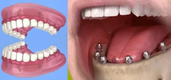 How Old Are Most People Who Choose Full-Mouth Dental Implants? (What the Research Really Shows) 6 Smile transformation achieved through full-mouth dental implants treatment plan