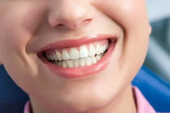 Dental comparison guide showing who should choose veneers vs whitening treatments