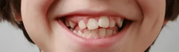 Patient with crooked and gapped teeth consulting dentist for Smile upgrade Yukon OK treatment options