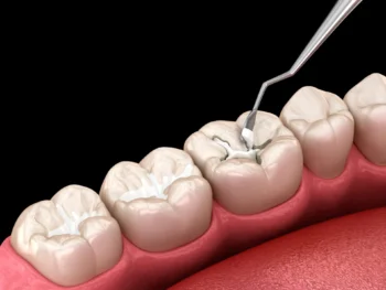 Dental sealants scaled 1