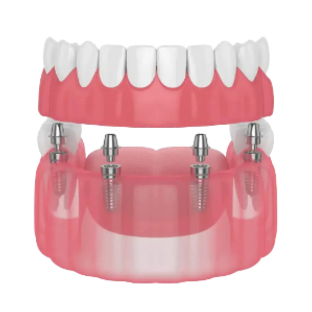 Fixed Full Arch