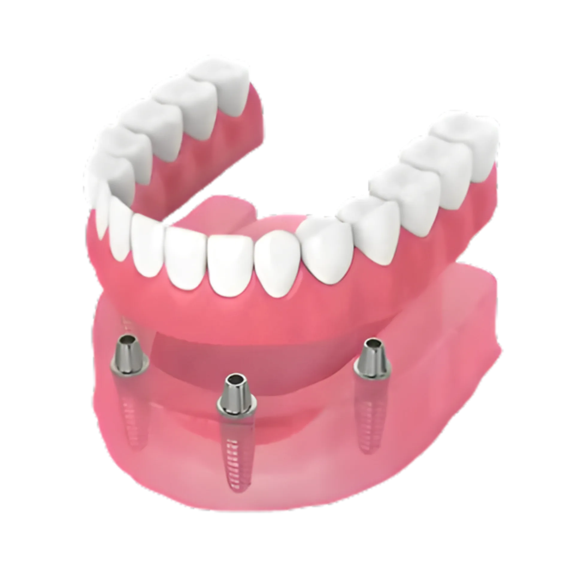 Snap-in Dentures