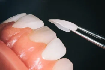 Dentist explaining difference between veneers vs whitening for smile enhancement