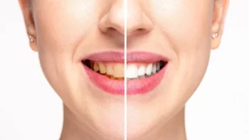 Before and after comparison of smile upgrade Yukon OK for teeth discoloration