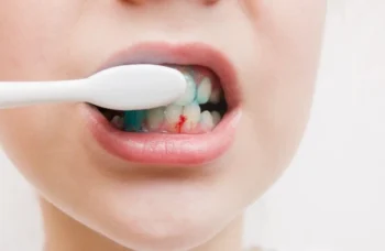 Bleeding gums while brushing as one of the signs you need a dental checkup