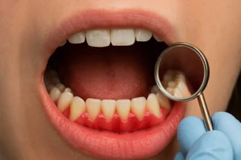 Dental examination for bleeding gums at dentist in Yukon OK clinic