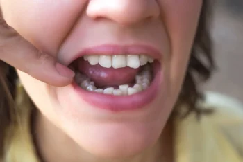 Patient receiving treatment for chipped and cracked teeth from dentist in Yukon OK clinic