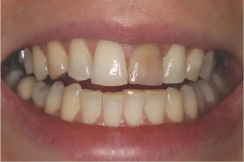 Dark spots and discoloration on teeth as possible signs you need a dental checkup