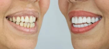 Smile Makeover