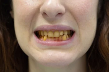 Tooth discoloration treated by dentist in Yukon OK using cosmetic dental procedures