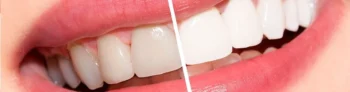 Smile design preview for Spring Smile Makeover dental procedure
