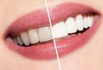 Patient smiling after professional teeth whitening Yukon OK treatment at dental clinic