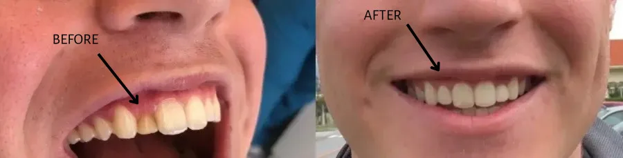Cosmetic Dentistry Before and After