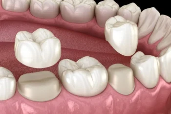 Restoring Smiles in Yukon OK – Dental Crowns for Damaged Teeth