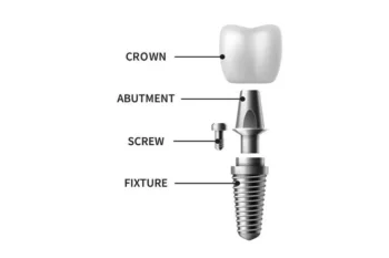 Dental Implants Yukon OK: What to Expect Step by Step 3 affordable dental implants procedure with dental crown and implant post