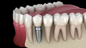 Restoring Smiles in Yukon OK – Replacing Missing Teeth With Dental Implants