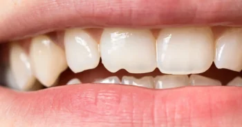 Top Signs You May Need Cosmetic Dental Treatment in Yukon OK 4 cosmetic dentist Yukon OK improving cracked and uneven teeth