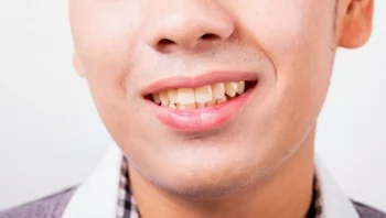 Top Signs You May Need Cosmetic Dental Treatment in Yukon OK 3 Close-up of stained teeth before cosmetic dental treatment in Yukon OK
