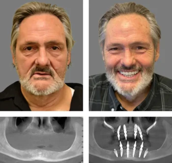 How Dental Implants Restore Smile Confidence in Yukon, OK 3 Before-and-after comparison of a man's smile alongside dental X-rays showing the placement of multiple dental implants.