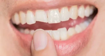 Emergency Dentist Yukon OK: What to Do If You Break or Knock Out a Tooth 2 If You Break a Tooth