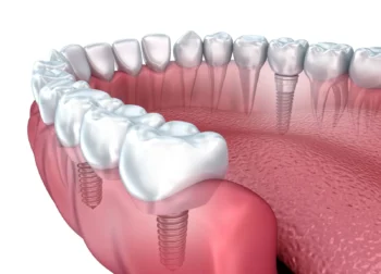 Oklahoma Medicaid Dental Coverage: What You Need to Know 2 Does Medicaid Cover Dental Implants? Understanding Medicaid Dental Coverage