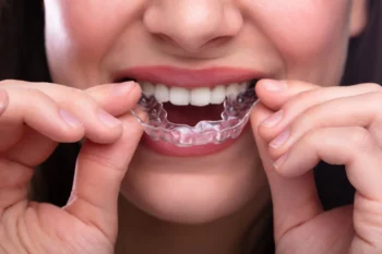 SureSmile vs Invisalign: Which Clear Aligner Is Right for You? 3 SureSmile vs Invisalign comparison showing Invisalign, a well-known clear aligner system that has helped millions of people straighten their teeth.