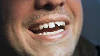 Chipped Tooth: When Should You See a Dentist? 3 Chipped Tooth with Severe Chips or Fractures