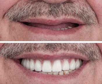 What Causes an Unsalvageable Tooth? 3 Unsalvageable Tooth replacement with a natural-looking dental restoration.