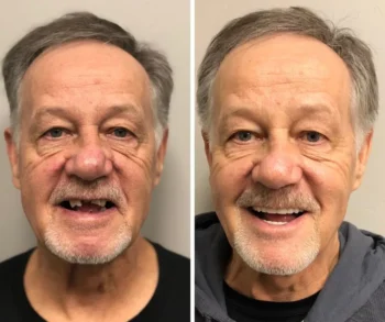 Same-Day Dentures Yukon OK | Restore Your Smile Faster 2 Same-Day Dentures Yukon OK