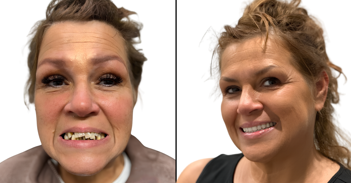 Snap-in Dentures. Before and after