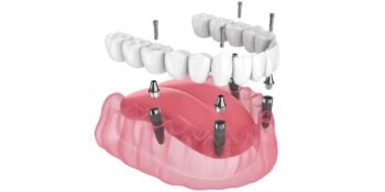 fixed dentures