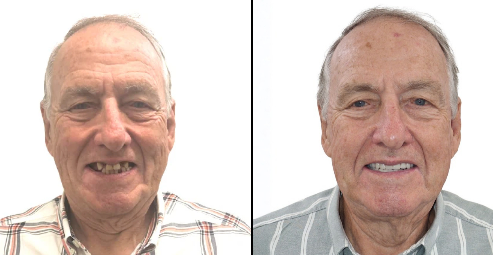 all-on-4 Before and After