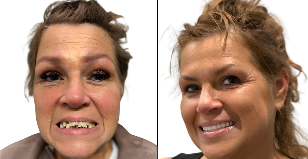 Before and After - Snap-in dentures