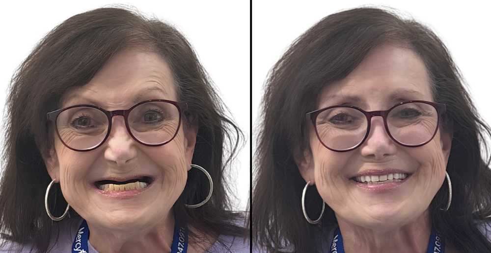 Before and After Snap-in dentures
